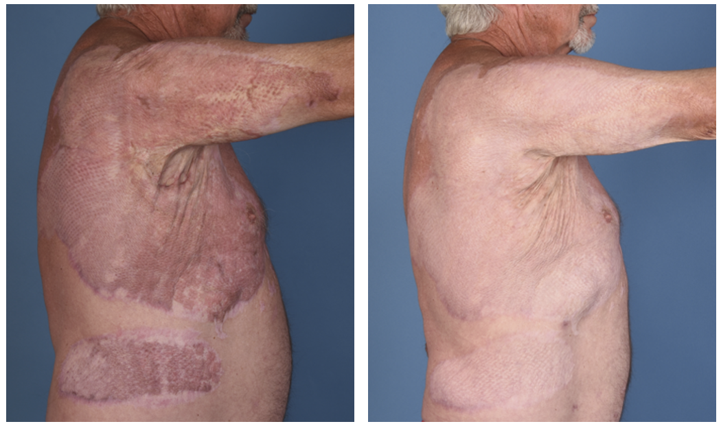 Extensive burn scar treatment showing dramatic improvement from severe scarring to significantly smoother skin texture